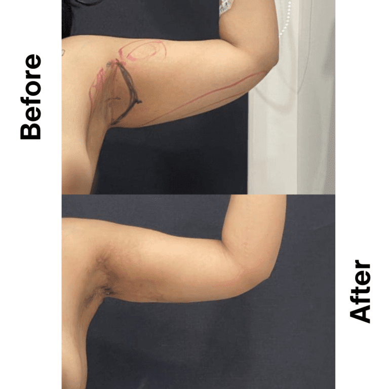 23-Year-Old Lady | 3 Months Post-Op | Post Weight Loss Transformation