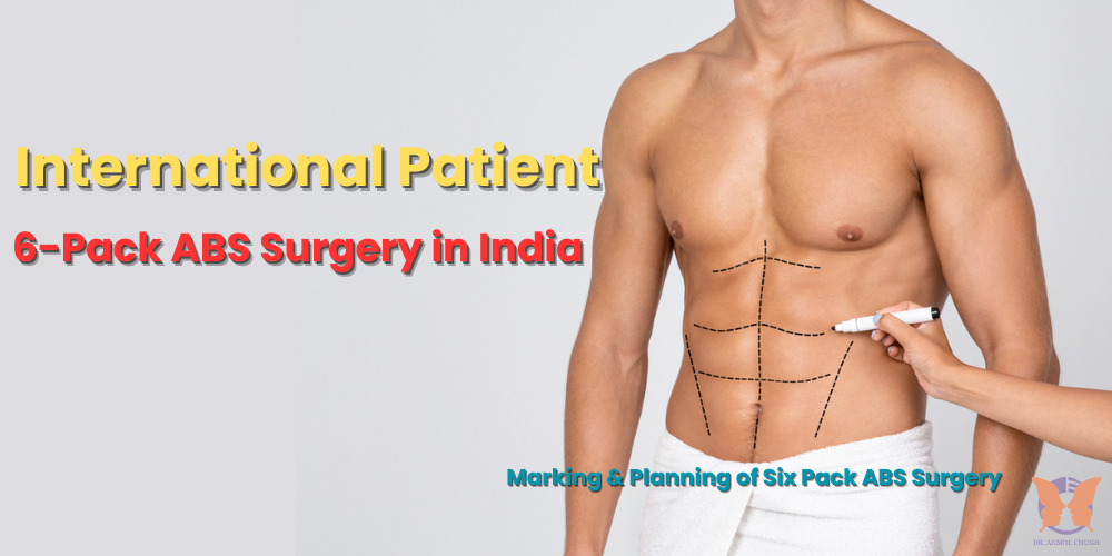 International patient 6-pack abs surgery in India