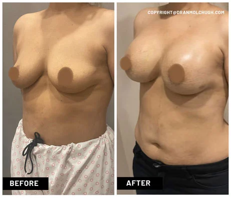 Breast Augmentation with Implants – Case Study for 40 year old female