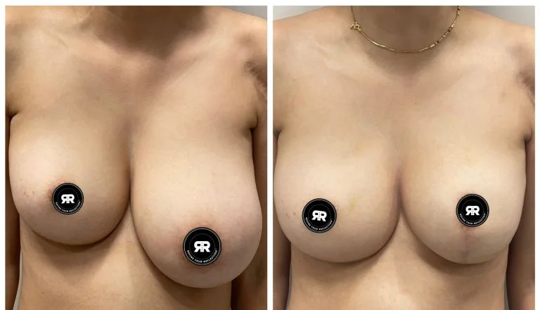 Real patient results after Breast Reduction surgery