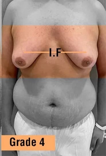 Gynecomastia Grade 4