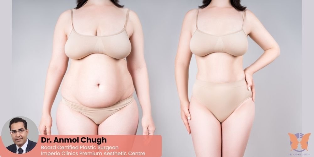Before and after natural-looking tummy tuck results with subtle contouring Before and after natural-looking tummy tuck results with subtle contouring