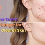 PRP for Acne Scars: A Game-Changer for Clearer Skin