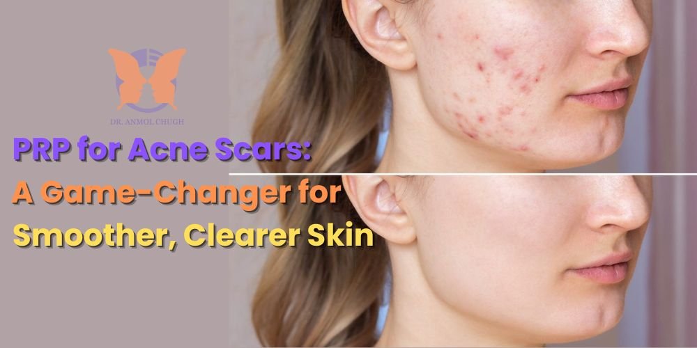 PRP for Acne Scars: A Game-Changer for Clearer Skin
