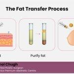 6 Reasons Why Fat Transfer Is a Natural Alternative to Implants
