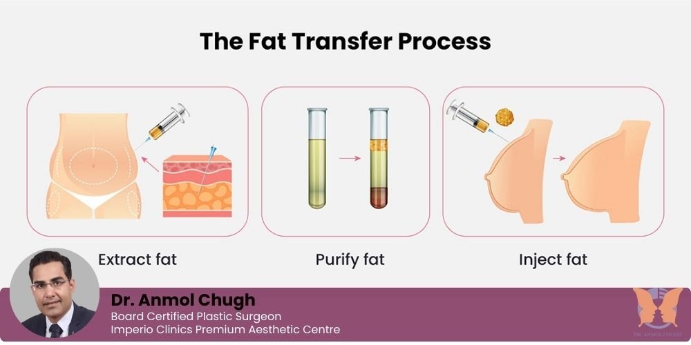6 Reasons Why Fat Transfer Is a Natural Alternative to Implants