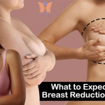 6 weeks breast reduction results 6 weeks breast reduction results