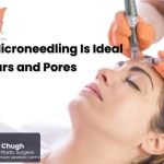7 Reasons Microneedling Is Ideal for Acne Scars and Pores