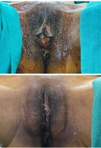 Before & After Labiaplasty