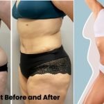 Tummy tuck results timeline – Before and after transformation showing realistic recovery stages