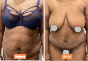 Before and after results of tummy tuck