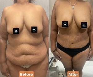 Tummy tuck before and after