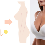 Natural breast fat transfer results enhanced curves boosting dressing confidence and body image Natural breast fat transfer results – enhanced curves boosting dressing confidence and body image