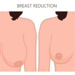 Natural breast reduction results balanced and proportionate breast shape for enhanced confidence Natural breast reduction results – balanced and proportionate breast shape for enhanced confidence