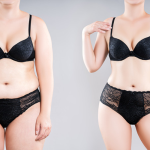 Post-tummy tuck dressing – woman wearing flattering outfit after surgery recovery