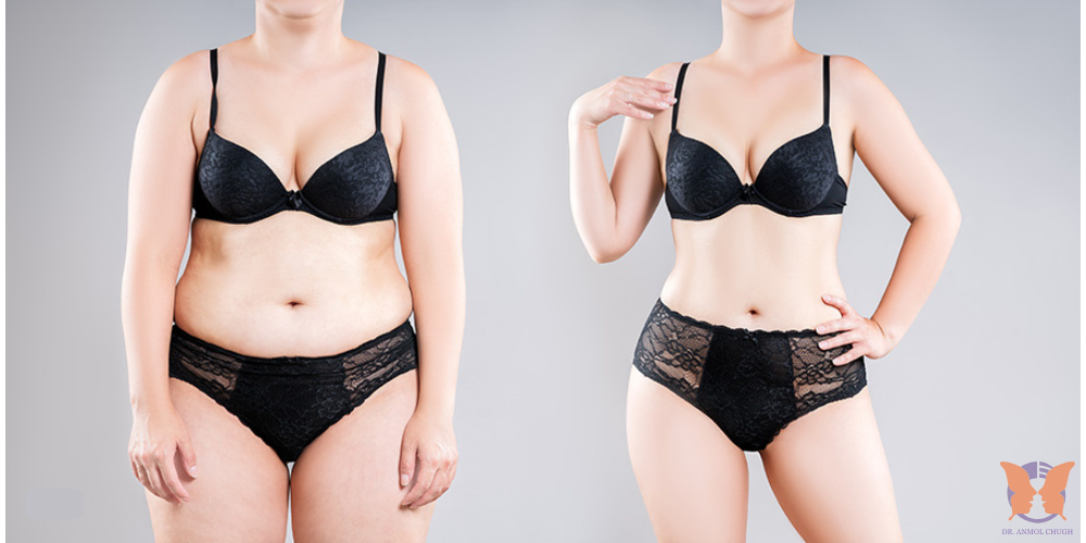 Post-tummy tuck dressing – woman wearing flattering outfit after surgery recovery