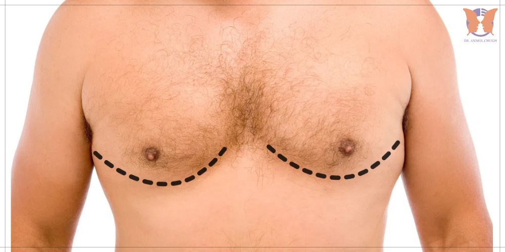 Safe gynecomastia surgery performed with advanced techniques and expert care