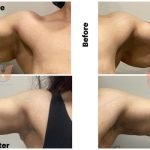 Arm Lift Surgery Case Study