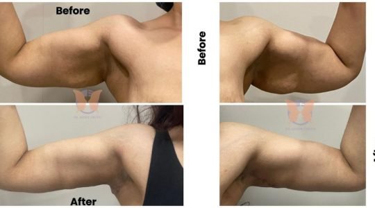 Arm Lift Surgery Case Study