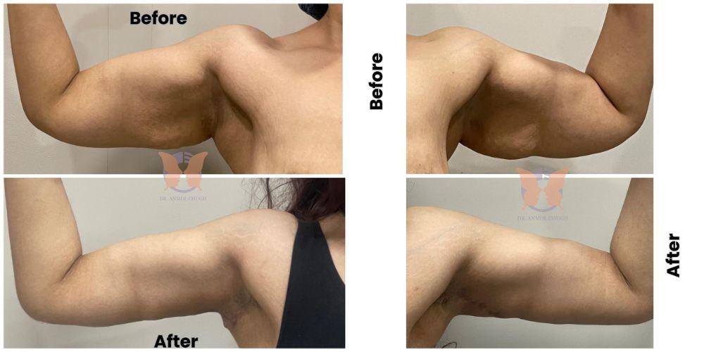 Arm Lift Surgery Case Study Arm Lift Surgery Case Study