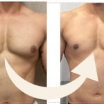 Before & After Gynecomastia Surgery: The Confidence Comeback