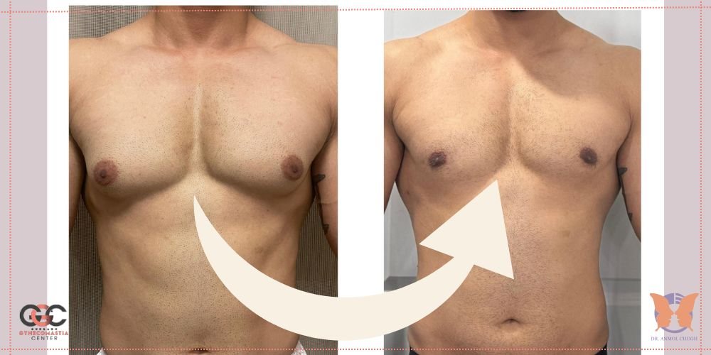 Before & After Gynecomastia Surgery: The Confidence Comeback