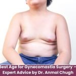Best age for gynecomastia surgery – Expert advice by Dr. Anmol Chugh