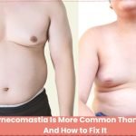 Why Gynecomastia Is More Common Than You Think