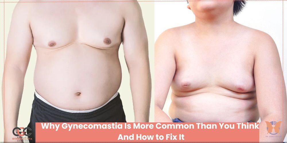 Why Gynecomastia Is More Common Than You Think And How to Fix It Why Gynecomastia Is More Common Than You Think