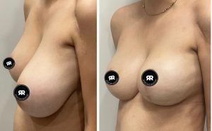 breast reduction 2 breast reduction results