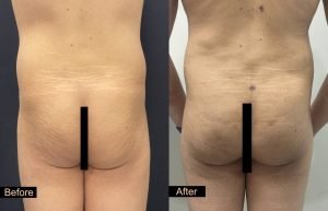 Male BBL 2 weeks post op 35 year old male