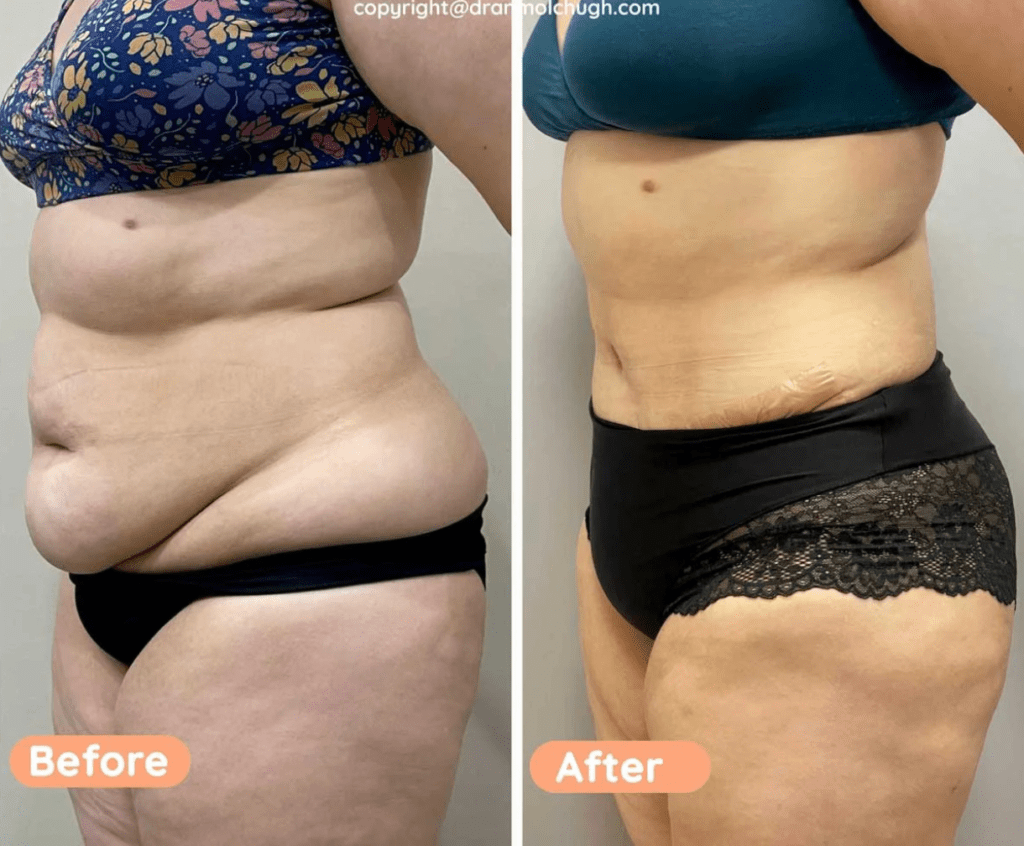 Real patient result after Tummy Tuck, 360 Liposuction