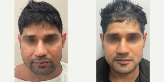 28 year old man treated with Ear Surgery Left Otoplasty Chin Implant