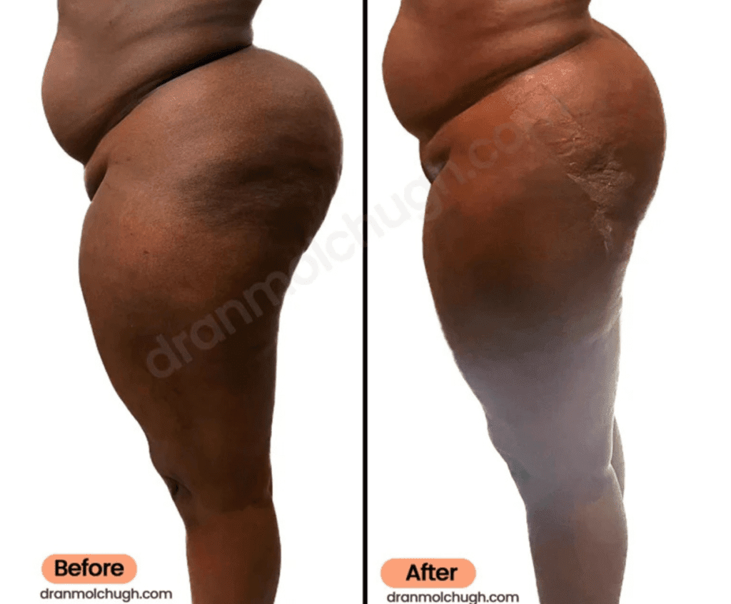 45 year old Women, 1 week post op – Buttock Liposuction