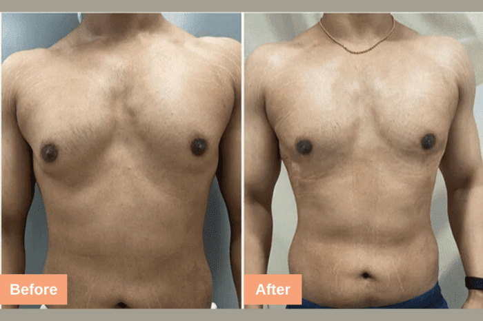 Grade 2 Gynecomastia