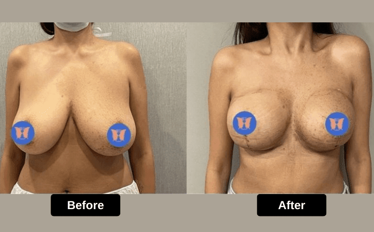 Breast Reduction with lift