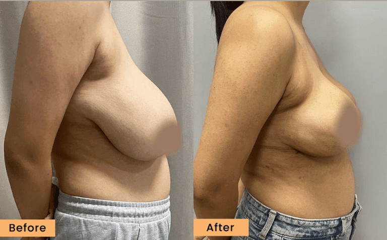 Breast Lift