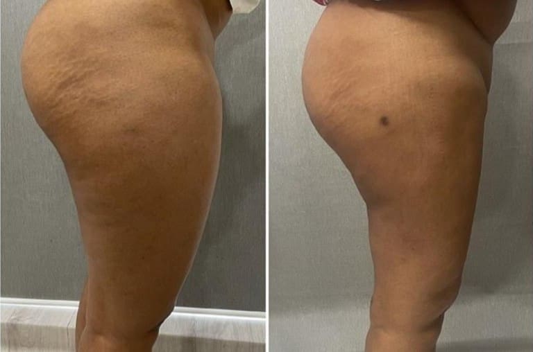 Post op Thigh Liposuction
