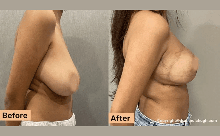 Breast Lift