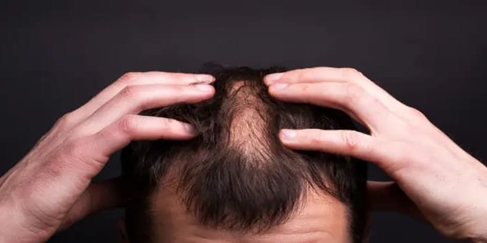 5-things you must do after Hair Transplant Treatment