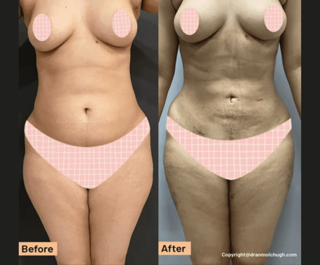 Tummy Tuck with High definition 360 Liposuction with thigh liposuction – 1 week postop