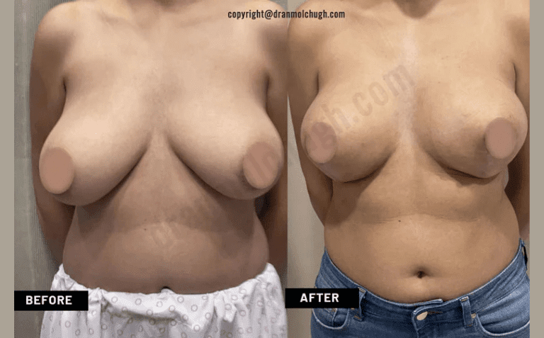 Breast Lift