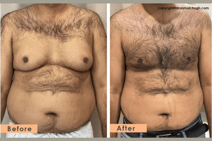 Grade 4 Gynecomastia