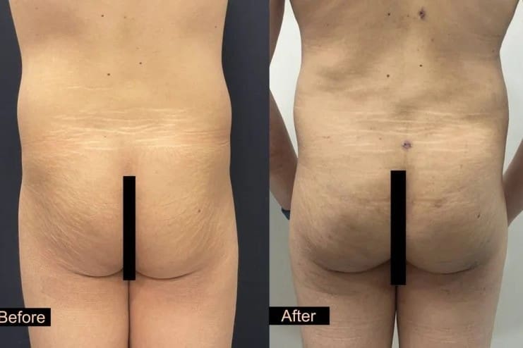 Male Brazilian Butt Lift Before and After