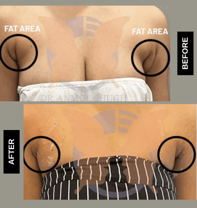 Axillary Breast Fat Pad Before and after