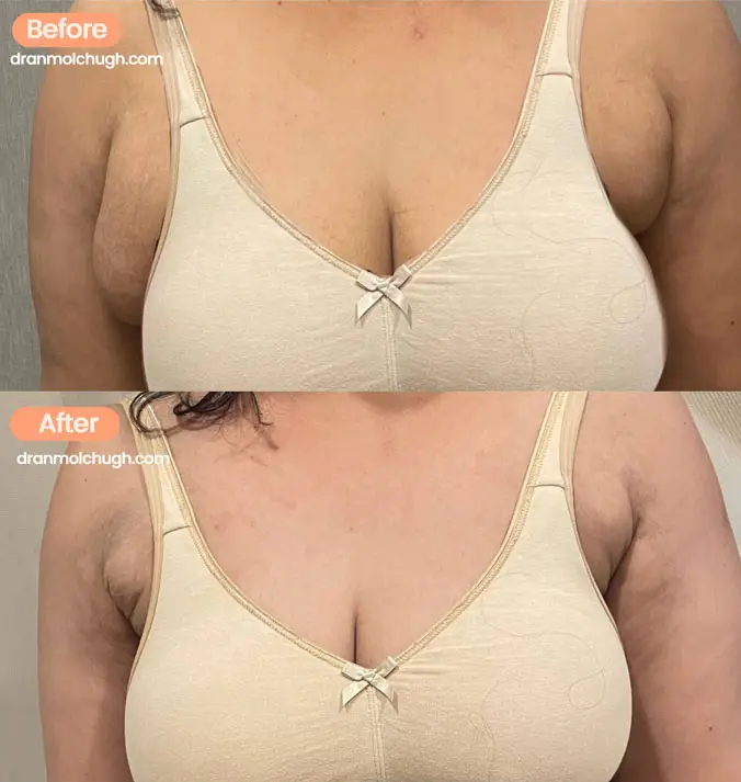 Axillary Breast Fat Pad Before and after