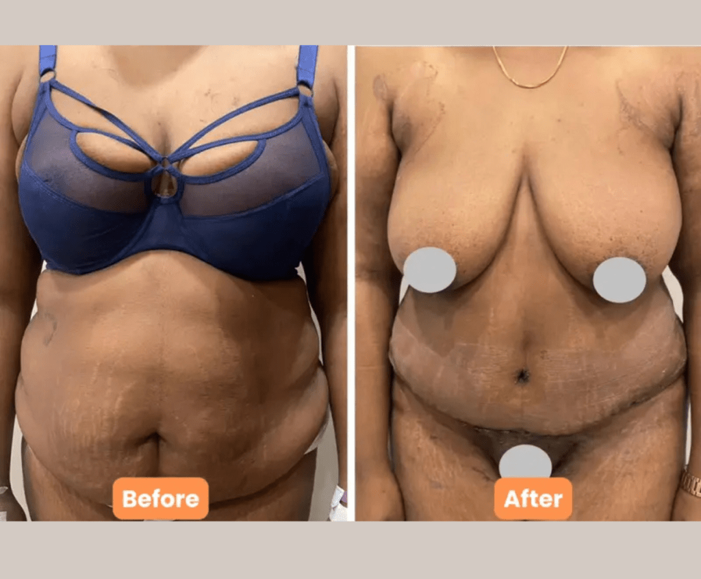 Mommy Makeover