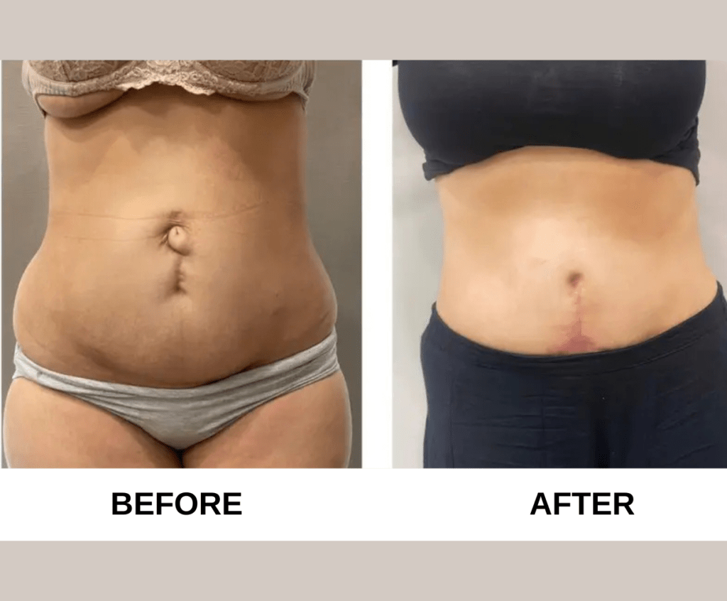Mommy Makeover
