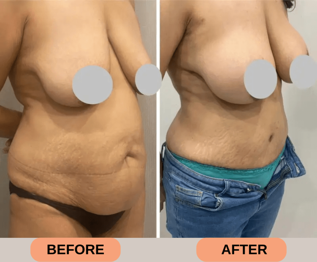 Mommy Makeover