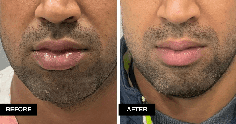 Lip Reduction result